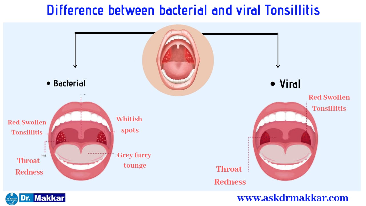 tonsils-tonsillitis-online-homeopathic-treatment-india-symptoms